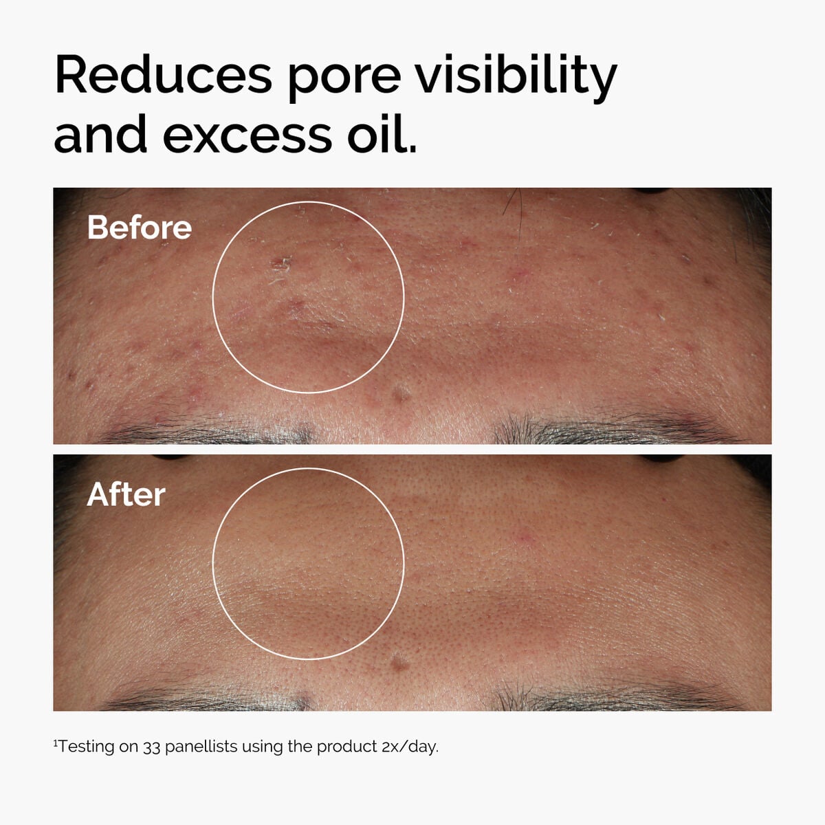 niacinamide-10-zinc-1-y4 ord-niacinamide-zinc-blemish-serum-before-after-pores.jpg