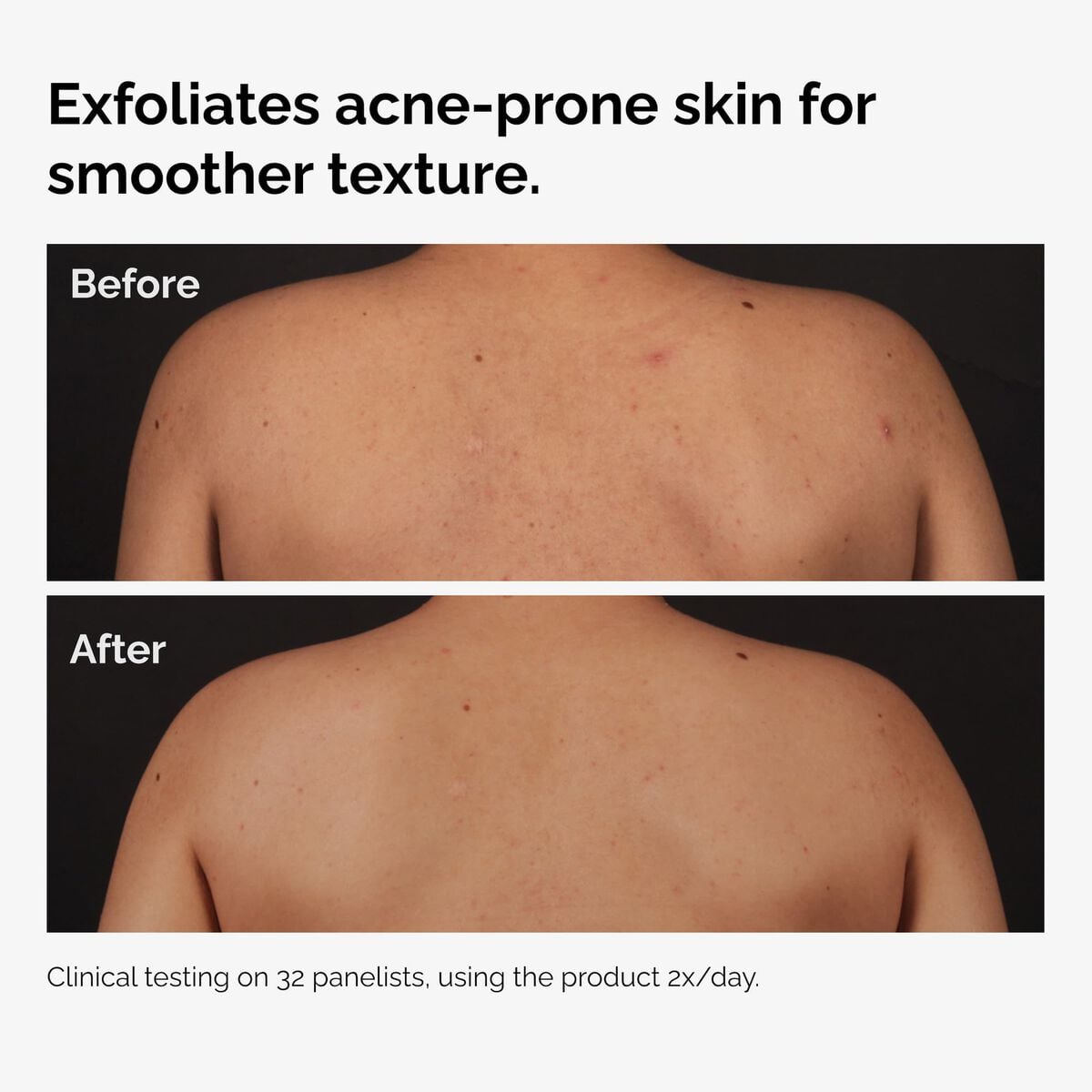 salicylic-acid-0-5-body-serum-j6 ord-salicylic-acid-body-serum-before-after-graphic-NA.jpg
