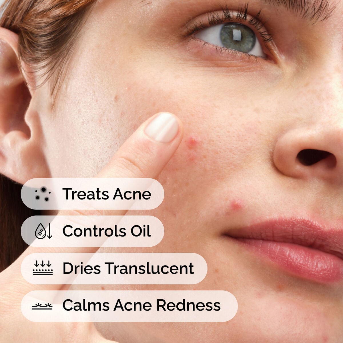 sulfur-10-powder-to-cream-concentrate-g3 ord-sulfur-10pct-powder-to-cream-concentrate-model-application-with-benefits-acne.jpg