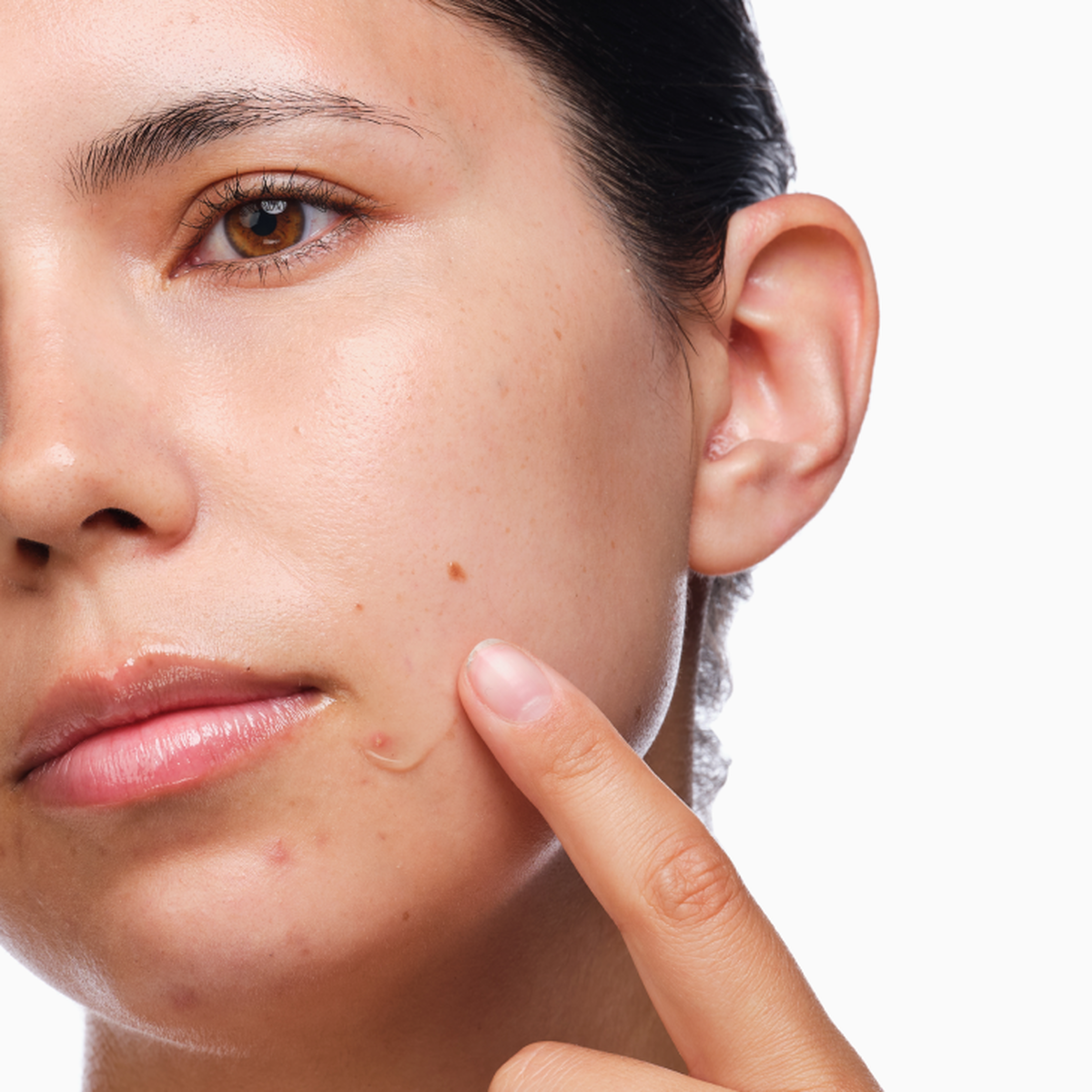 the-acne-set-o6 rdn-the-acne-set-application.png